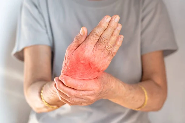 Inflammatory Arthritis