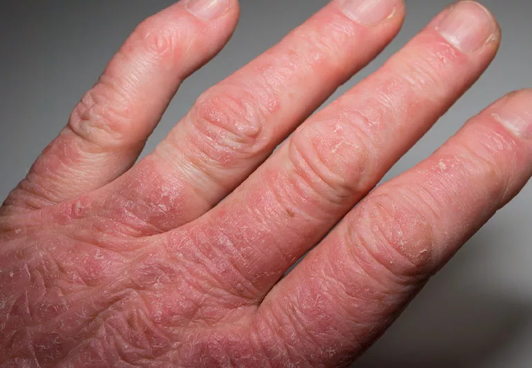 Psoriatic Arthritis