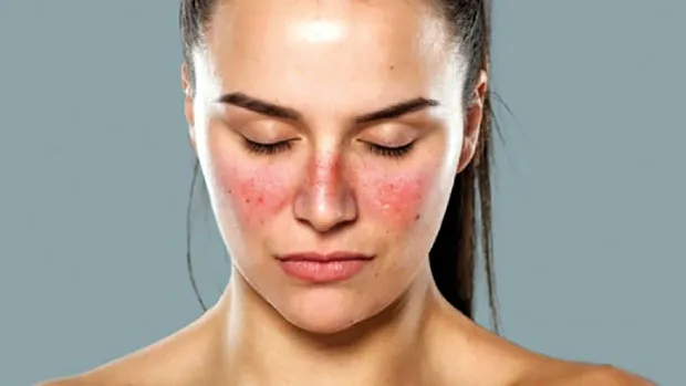 Systemic Lupus Erythematosus